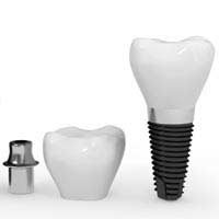 Dental Implants Dentures Bridge