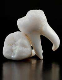 Bone Loss Implants Dental Jaw Teeth