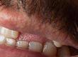 What Causes Tooth Loss?