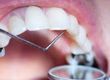 Dental Repairs - What is the General Expiry?