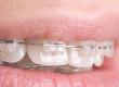 The Gap in My Teeth Reappeared: What Can I Do?