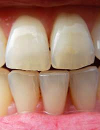 Oral Habits Dental Dentist Smoking