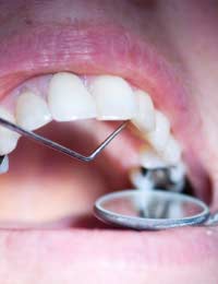 Dentist Fillings Longevity Repairs