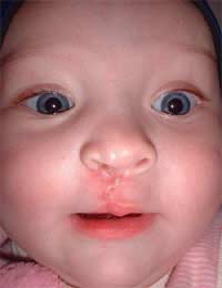 Cleft Lip Cleft Palate Lip Palate