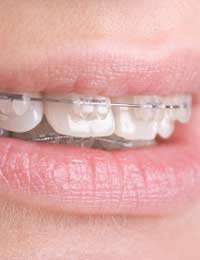Gap Front Teeth Orthodontic Treatment