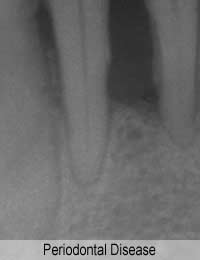 Gum Disease Periodontal Disease