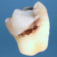 World Dental Loss Decay Dentist Access