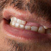 Tooth Loss Social Effects Family Friends