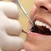 Periodontists Implants Gingivitis Dental